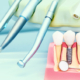Implantatmodell auf einer Ablage. Im Hintergrund Zahnarztequipment